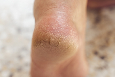 Exploring the Root Causes of Cracked Heels