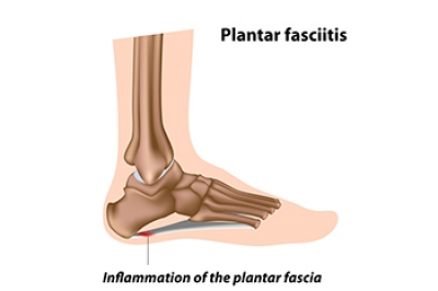 Common Causes of Plantar Fasciitis Unveiled