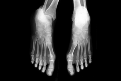 Causes and Risk Factors of Foot Stress Fractures