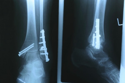 Exploring Ankle Replacement Surgery