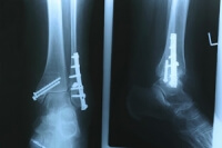 Exploring Ankle Replacement Surgery