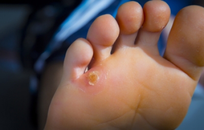 Causes and Definition of Corns on the Feet